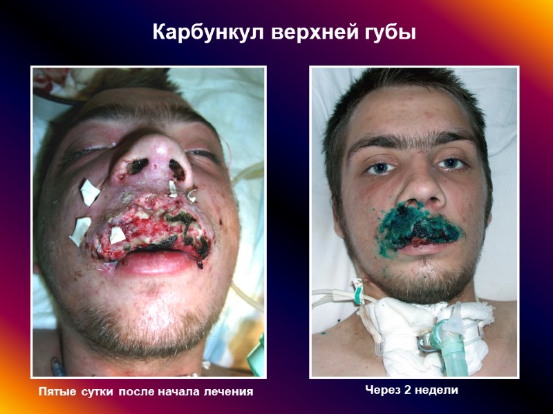 Карбункул верхней губы Пятые сутки после начала лечения Через 2 недели